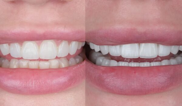 composite veneer & ceramic veneer مقایسه کامل کامپوزیت ونیر و لمینیت سرامیکی composite Vs. ceramic veneer