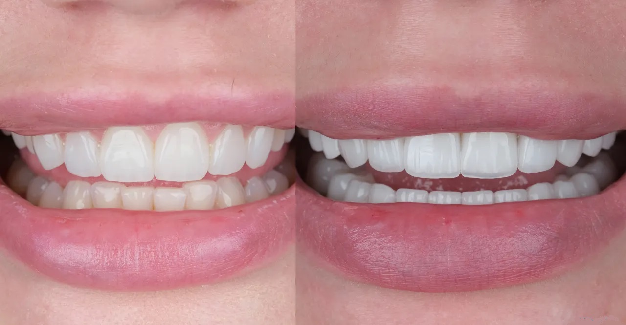 مقایسه کامل کامپوزیت ونیر و لمینیت سرامیکی composite Vs. ceramic veneer 1 composite veneer & ceramic veneer مقایسه کامل کامپوزیت ونیر و لمینیت سرامیکی composite Vs. ceramic veneer