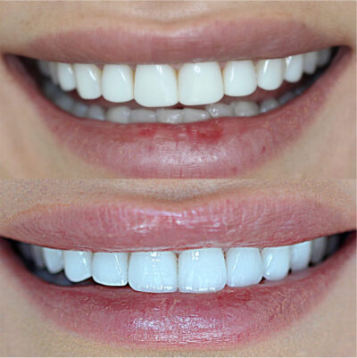 مقایسه کامل کامپوزیت ونیر و لمینیت سرامیکی composite Vs. ceramic veneer 3 composite veneer & ceramic veneer
