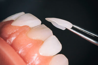 مقایسه کامل کامپوزیت ونیر و لمینیت سرامیکی composite Vs. ceramic veneer 2 ونیر دندان زیبایی دندان