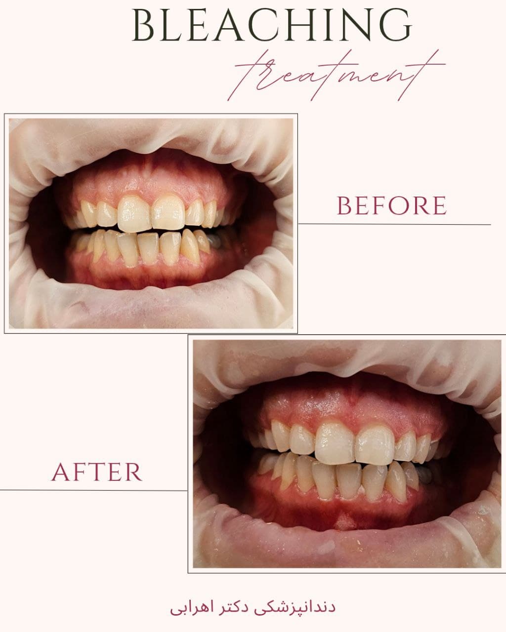 دندان های سفید و زیبا با بلیچینگ دندان