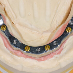 دندان مصنوعی ایمپلنت شده