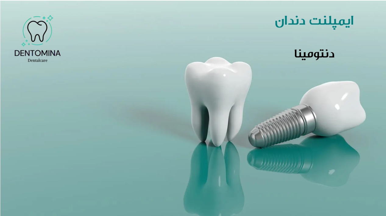 ایمپلنت دندان مطب دندانپزشکی دکتر اهرابی