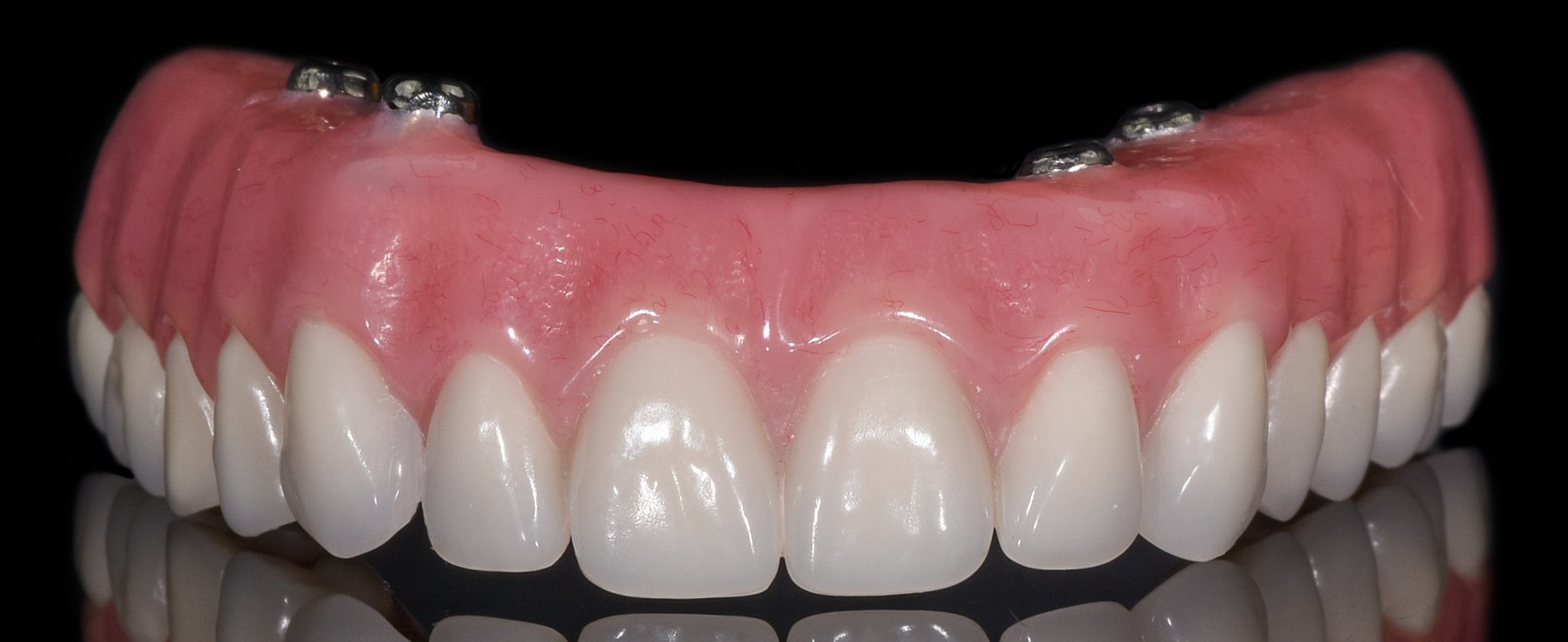 اوردنچر چیست؟ Overdenture