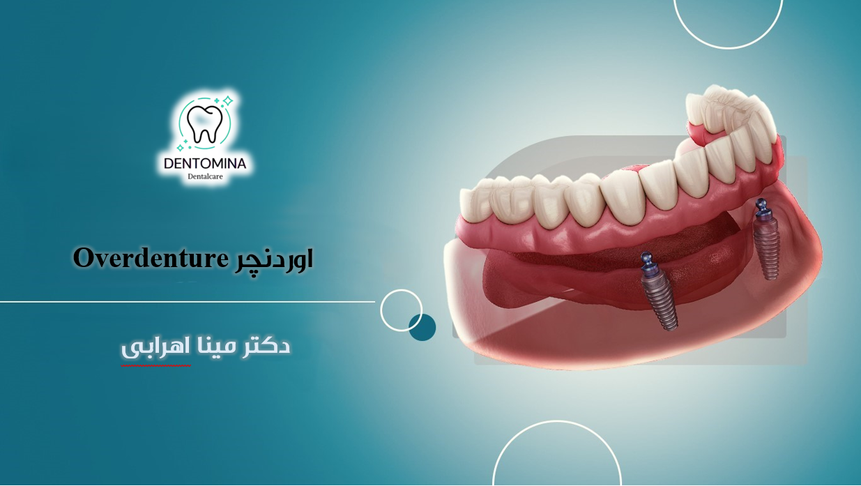 Overdenture