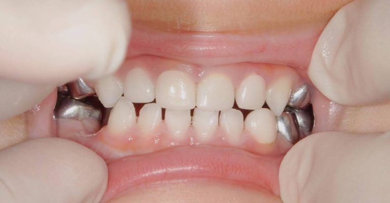 روکش استیل (SSC)