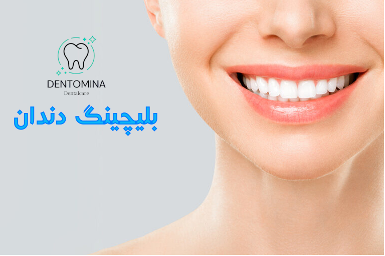 بلیچینگ دندان bleaching