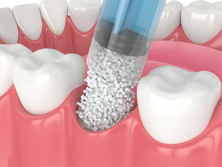 bone grafting filling