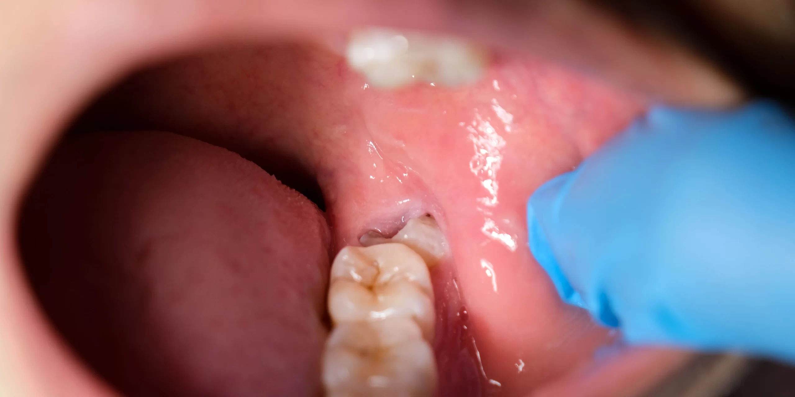 همه چیز درباره دندان عقل (Wisdom Teeth): از رویش تا جراحی و مراقبتها 2 دندان عقل نهفته (Impacted Wisdom Tooth)