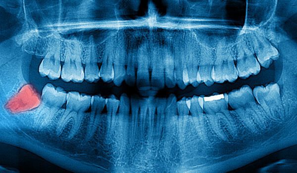 همه چیز درباره دندان عقل (Wisdom Teeth): از رویش تا جراحی و مراقبتها 1 wisdom teeth دندان عقل