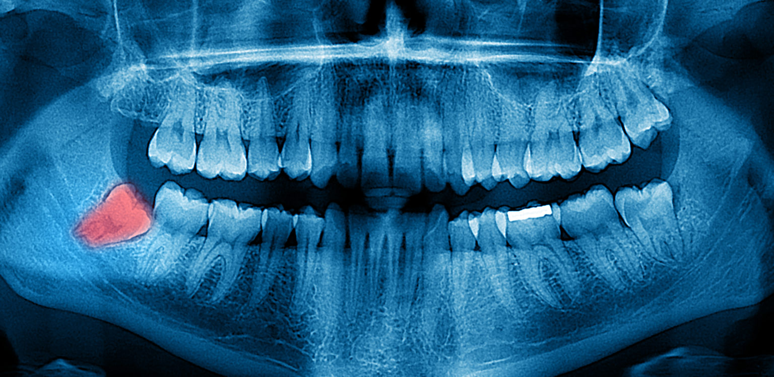 همه چیز درباره دندان عقل (Wisdom Teeth): از رویش تا جراحی و مراقبتها 1 wisdom teeth دندان عقل