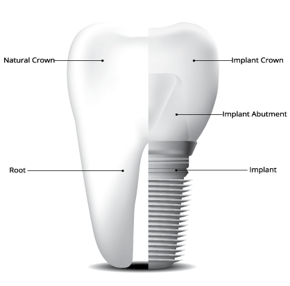 ایمپلنت ارزان