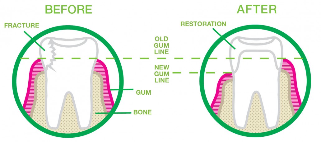 درمان لبخند لثه‌ای