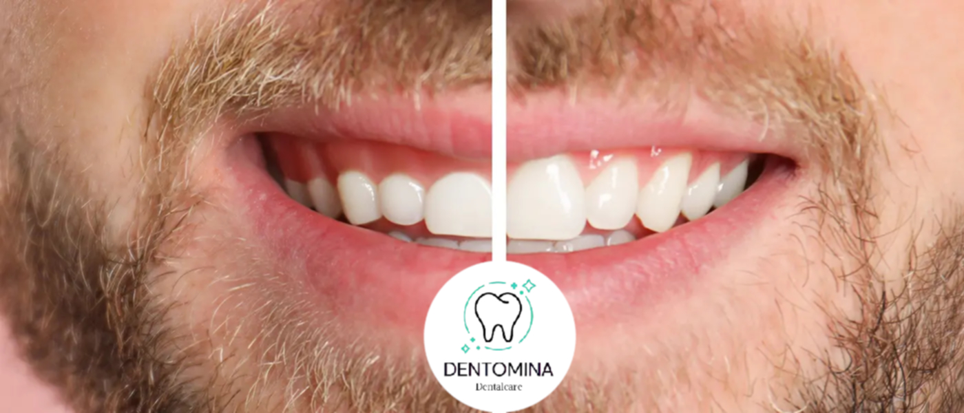 Gummy Smile اصلاح لبخند لثه‌ای جراحی افزایش طول تاج