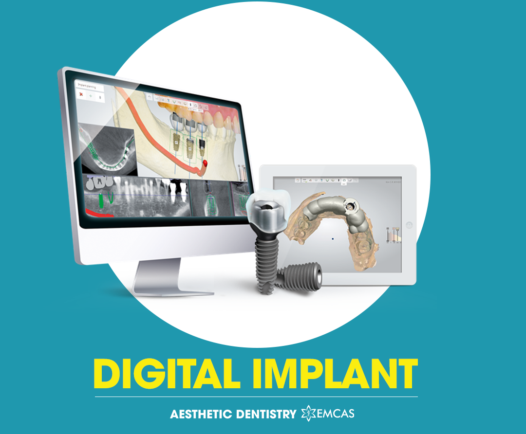 ایمپلنت فوری، پانچ، سنتی و دیجیتال: راهنمای کامل از نگاه متخصص ایمپلنت dental-implant-techniques 5 ایمپلنت دیجیتال (Digital Implant)