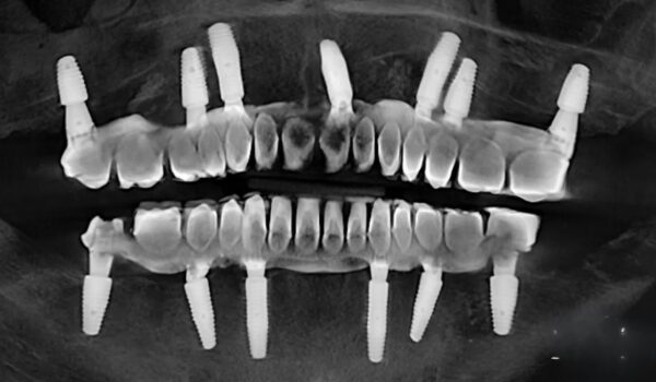 ایمپلنت فوری، پانچ، سنتی و دیجیتال: راهنمای کامل از نگاه متخصص ایمپلنت dental-implant-techniques