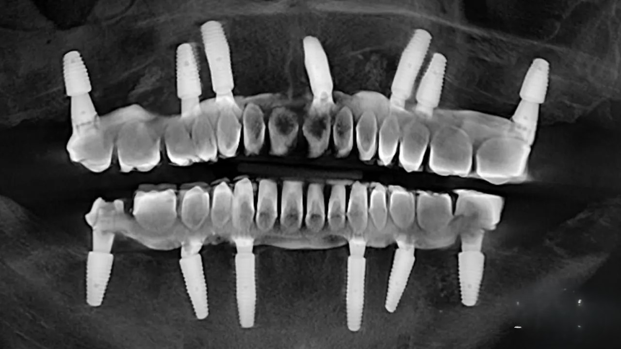 ایمپلنت فوری، پانچ، سنتی و دیجیتال: راهنمای کامل از نگاه متخصص ایمپلنت dental-implant-techniques 1 ایمپلنت فوری، پانچ، سنتی و دیجیتال: راهنمای کامل از نگاه متخصص ایمپلنت dental-implant-techniques