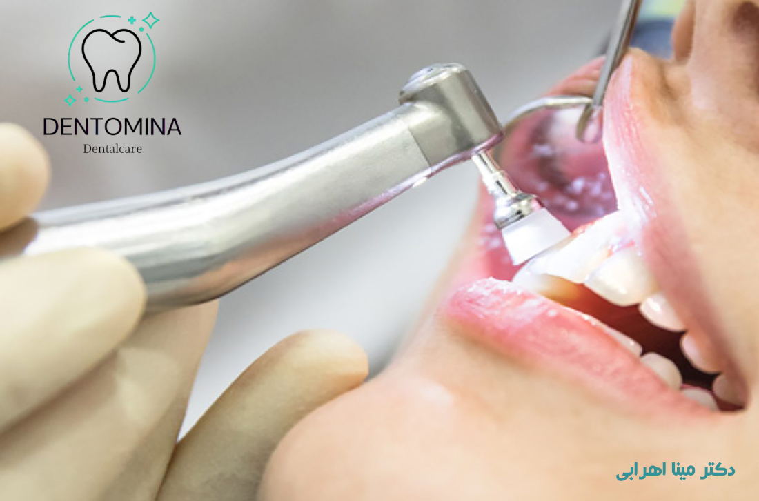 جرم‌گیری و بروساژ دندان