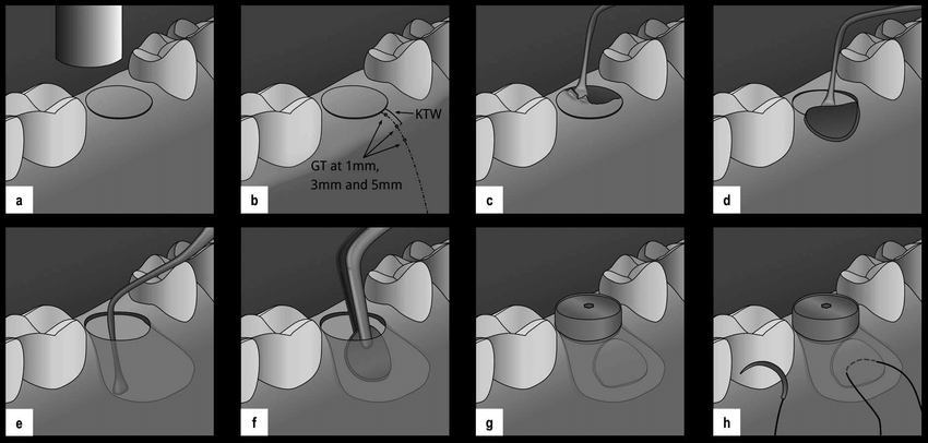 ایمپلنت فوری، پانچ، سنتی و دیجیتال: راهنمای کامل از نگاه متخصص ایمپلنت dental-implant-techniques 4 ایمپلنت پانچ: کمتهاجمی و راحت