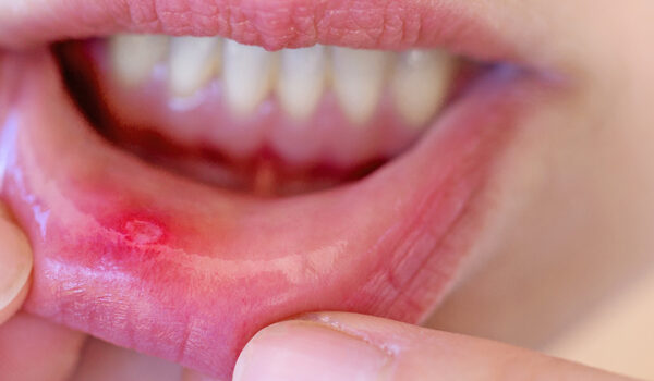 canker sore