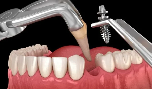 ایمپلنت فوری چیست؟ حقایق، مزایا و معایب کاشت دندان فوری