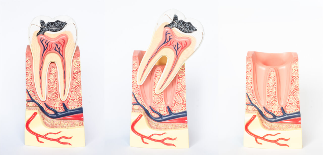 (Dry Socket / Alveolar Osteitis) 